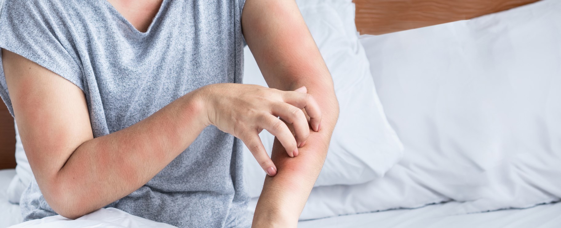 Person kliar arm efter att ha fått kliande bett av vägglöss.