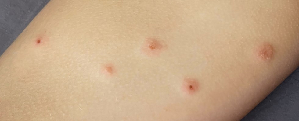 bild på vägglus, vägglöss - på engelska kallat bedbug. Bilden kommer från Istock